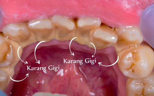 karang gigi